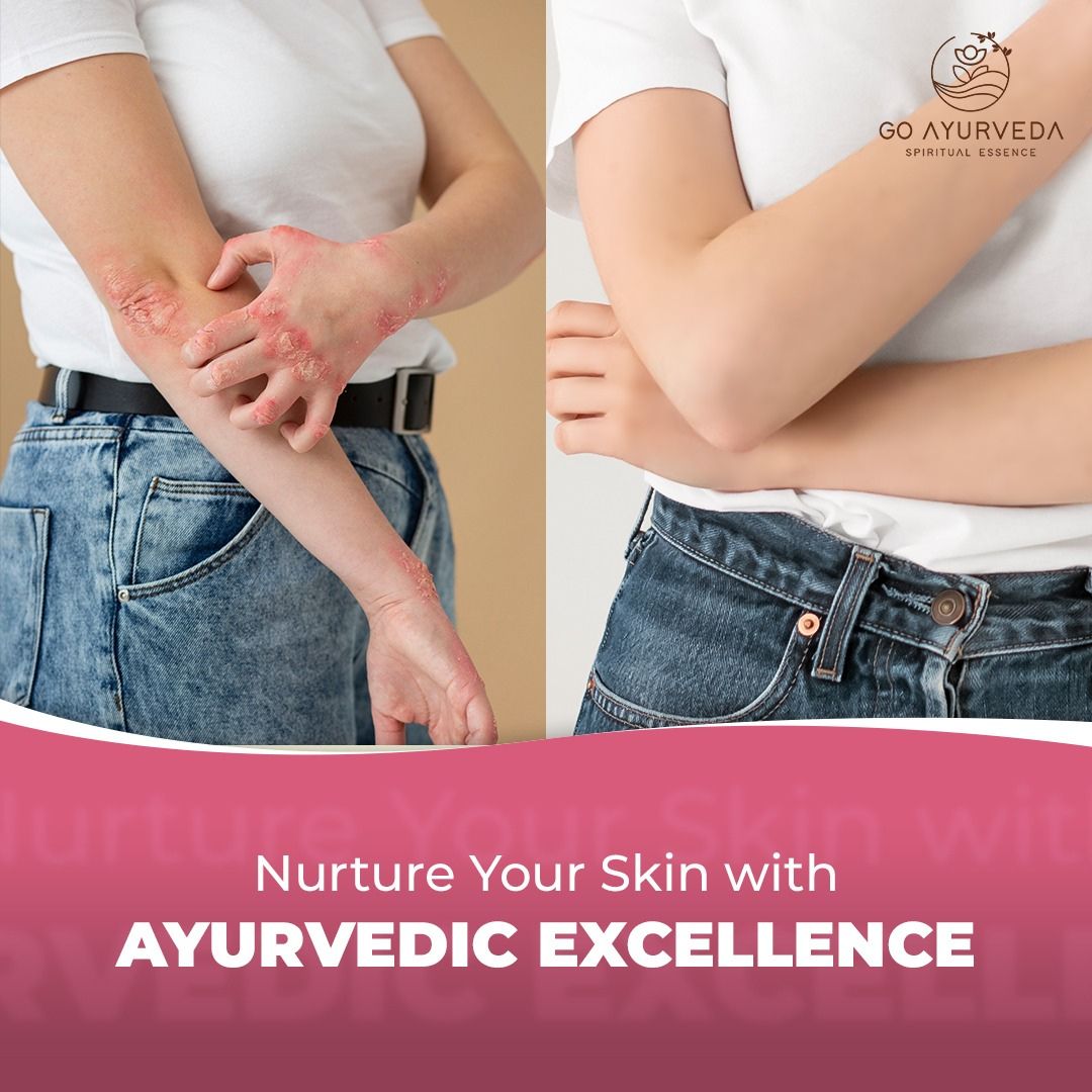 Derm Care Oil Roll On | Fights Psoriasis, Eczema, Rashes, Itching | Promotes Regeneration of Skin Cells | 80ml