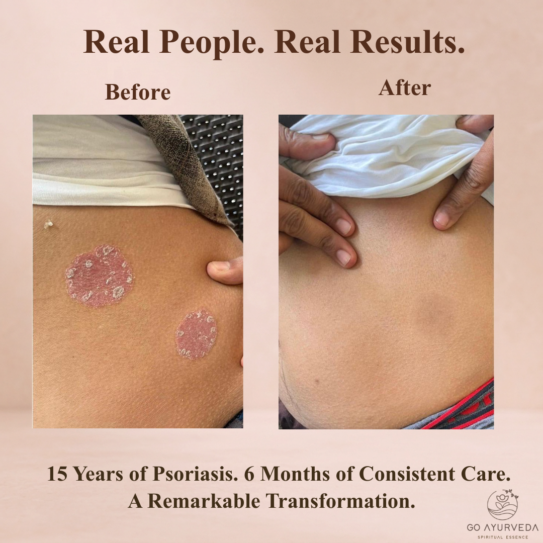 Derm Care Solution - Ayurvedic Capsules & Oil Roll-On for Psoriasis, Eczema & Itching