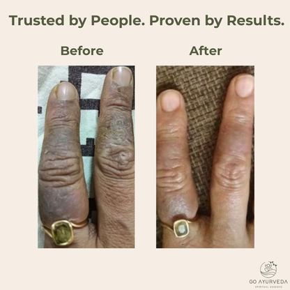 Derm Care Oil Roll-On - Ayurvedic Oil for Psoriasis, Eczema, Itching & Rashes